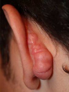 Posterior Auricular Keloid