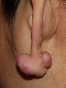 Earlobe Keloids