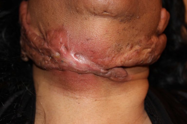 Severe infection of a massive neck keloid. Severe infection of a massive neck keloid.