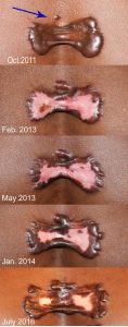 Keloid Growth over time