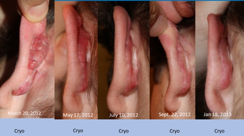 Post Otoplasty Keloid - Treatment Results. 