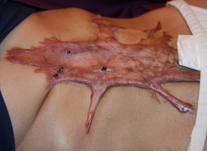 Extensive Abdominal Keloid Formation after several prior surgeries