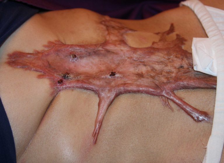 Extensive Abdominal Keloid