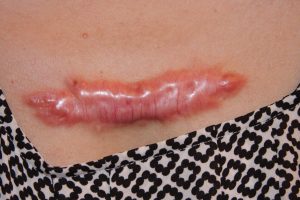 hyper-inflammatory painful chest keloid