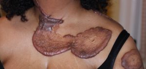Extensive Neck and Chest Keloid Formation after several prior surgeries and radiation therapy.
