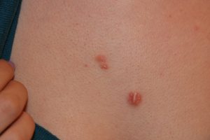 Early Stages of Chest Keloid