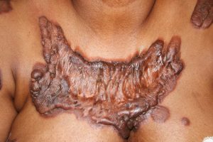 Extensive chest keloid with hyper-inflammatory borders