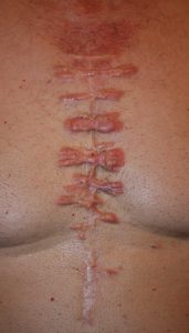 Post heart surgery chest keloid