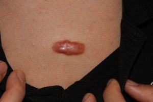 Solitary Chest keloid