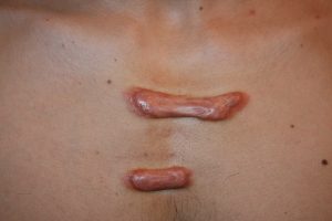 Parallel Chest keloids