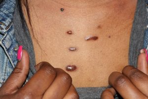 Multifocal chest keloids