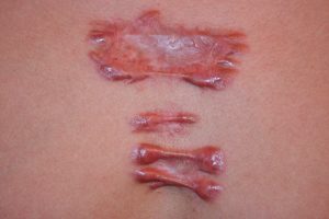 hyper-inflammatory Extensive chest keloid