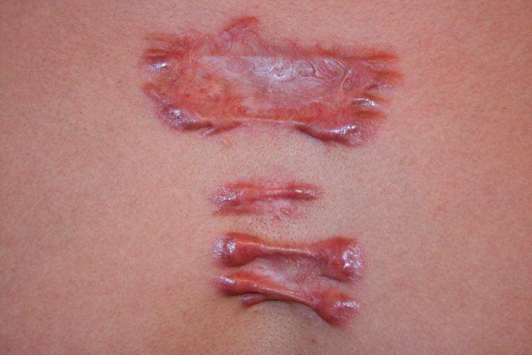 Hyper-Inflammatory Chest Keloid