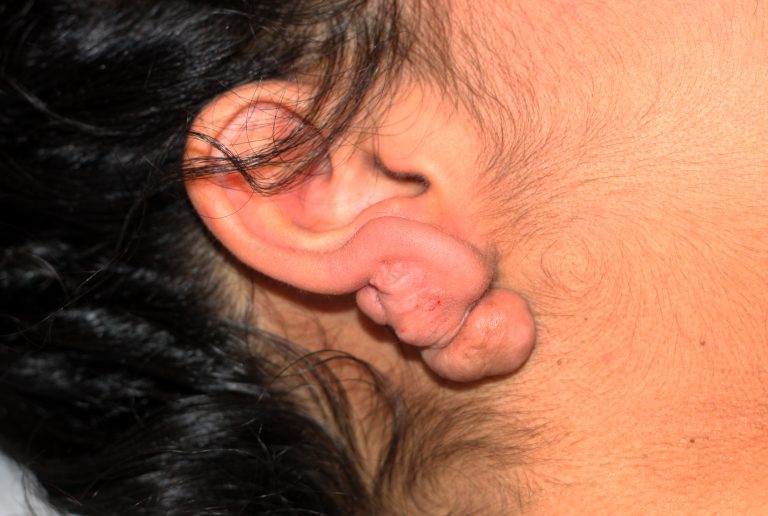 Earlobe Keloids - Treatment Outcome with Cryotherapy