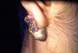 Necrotic Earlobe Keloid
