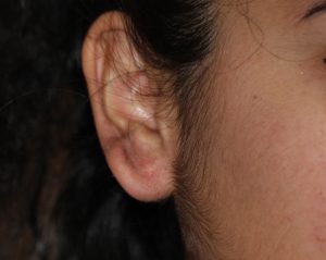earlobe keloid treated with cryotherapy