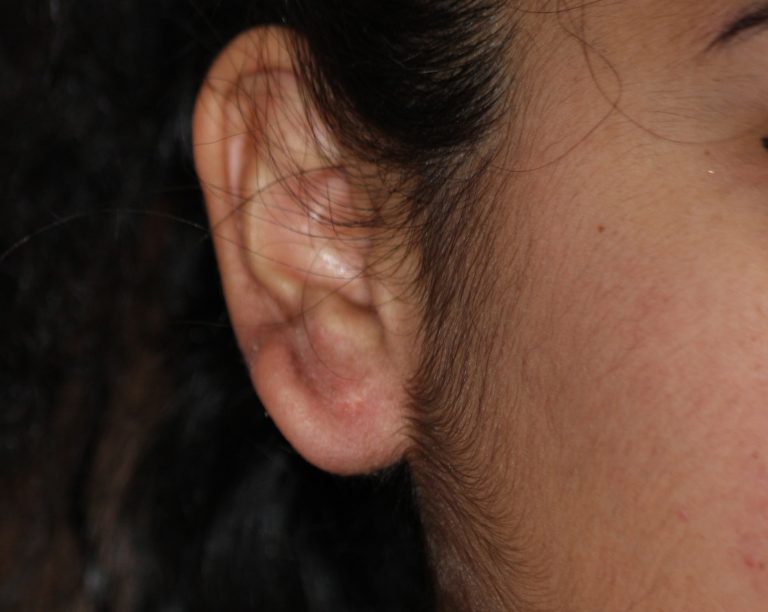 Keloid Treatment with Cryotherapy