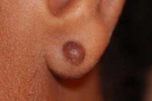 Early Stage of Earlobe Keloid