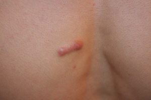 Linear Chest Keloid in an Asian patient