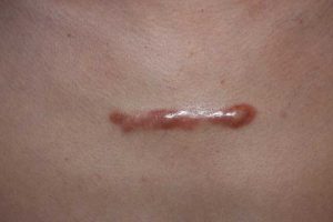 Linear Chest Keloid in an Asian patient