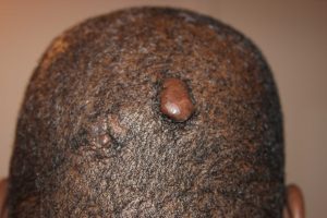 Tumoral Scalp Keloid