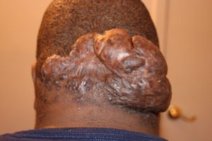 Massive Scalp Keloid