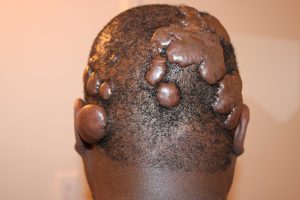 Multifocal Scalp Keloids