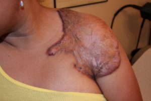 Large Keloid Patch after keloid surgery