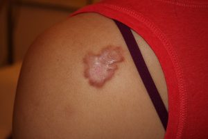 Patchy Shoulder Keloid