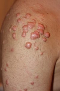 Nodular Shoulder Keloids