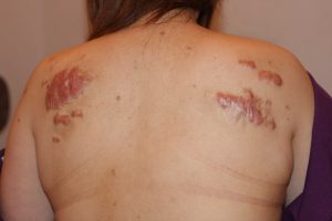 Shoulder Keloid Surgery