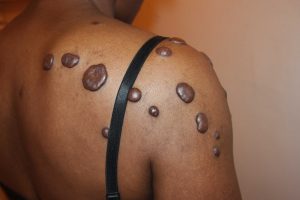 multiple shoulder keloids