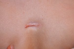 Linear Keloid with Skin Atrophy and loss of pigment from repeated injections with high doses of steroids