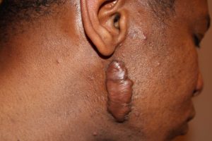 Recurrent face keloid after surgical removal.