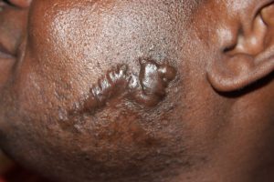 Recurrent keloid after surgical removal