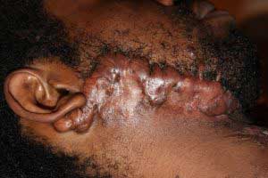 Severe Face Keloid due to surgery