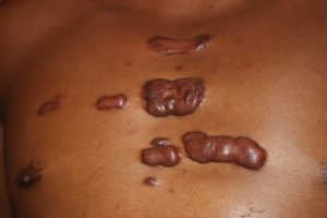 Mixed variety keloids in chest wall