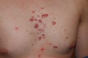 Mixed variety keloids in chest wall