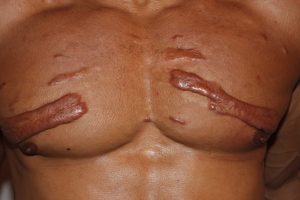 Mixed variety keloids in chest wall