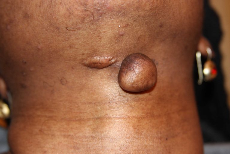 Tumoral Neck Keloid