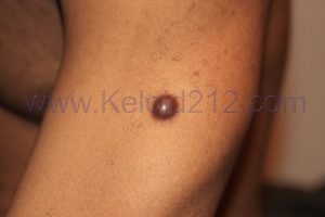 Nodular Keloid