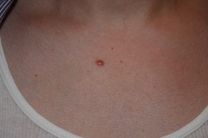 Keloid Papule