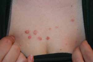 Multiple keloidal papules in chest wall.