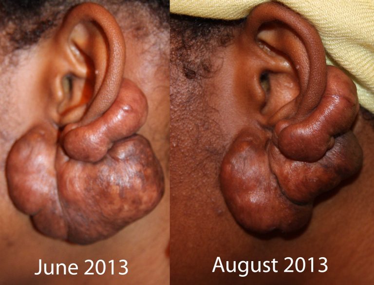 Massive Ear Keloid