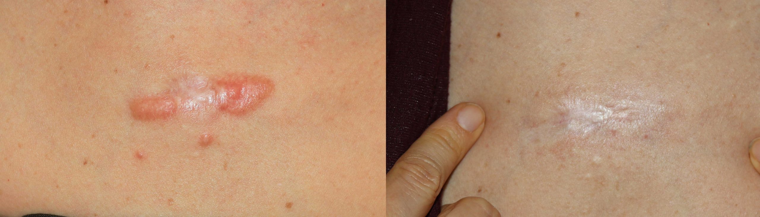 Chest keloids Treated with chemotherapy