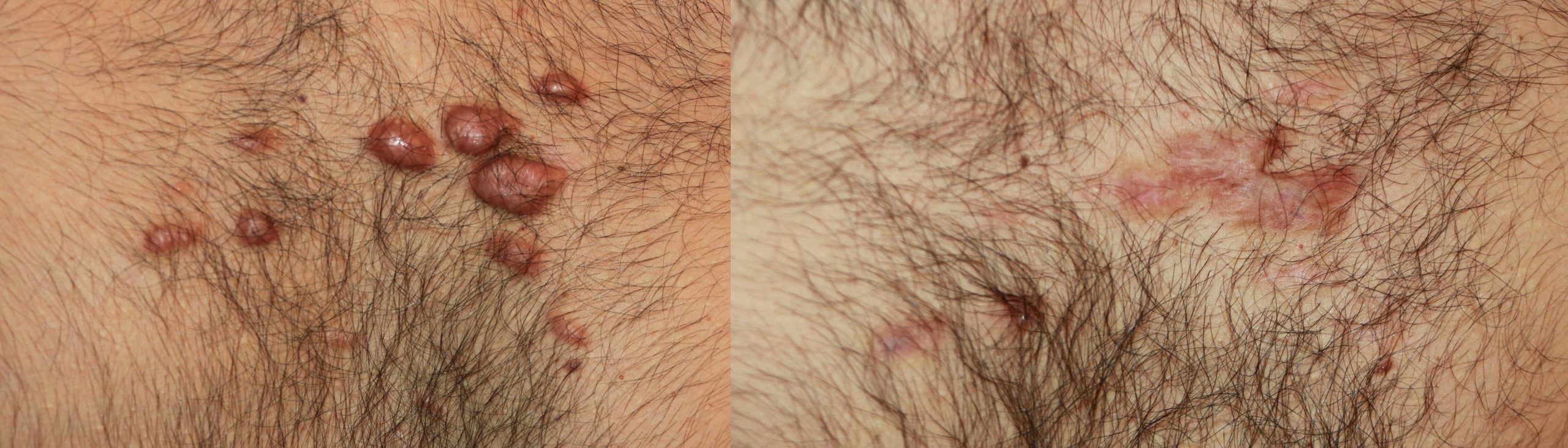Chest keloids Treated with chemotherapy Chest keloids Treated with chemotherapy