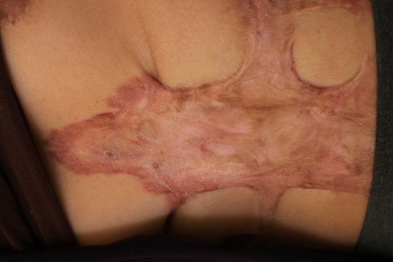 Extensive Abdominal Keloid