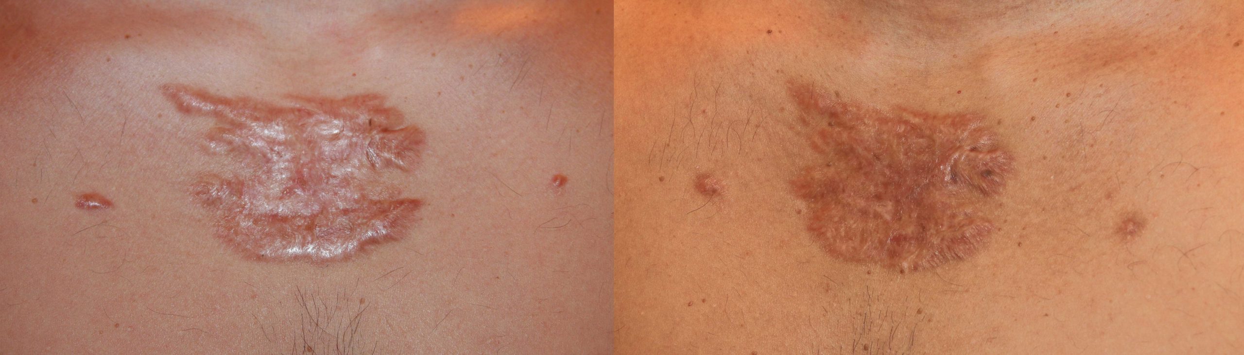 Chest keloids Treated with chemotherapy