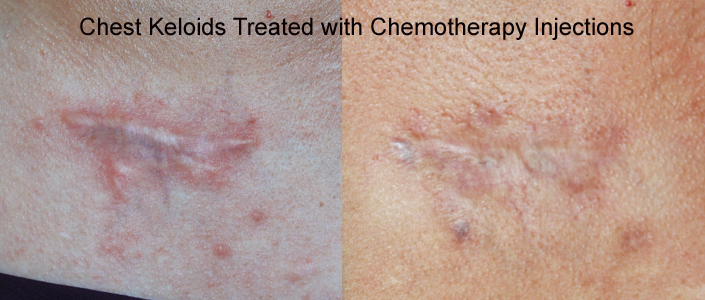 Chest keloids Treated with chemotherapy Chest keloids Treated with chemotherapy