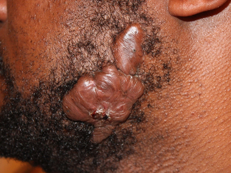 Massive face keloid removal